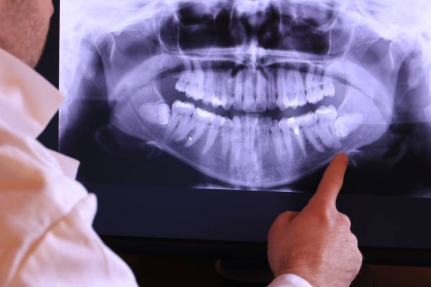 Best Emergency Wisdom Teeth Removal in White Bluff, TN